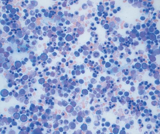 Bone marrow aspirate.