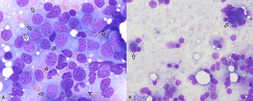 A) Increased myeloid blasts (arrows) and hypogranular neutrophils (arrowheads; 100×); B) dysplastic megakaryocytes including small, hypolobate forms and multinucleated forms (arrows; 50×).