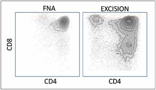 Case 1 illustrates that flow cytometry and ancillary tests often cannot compensate for poor or minimal sampling. It is well-established that the specificity of both flow cytometry and molecular methods for detection of clonality depends on the number of cells and fraction of neoplastic cells in a specimen. Here, the flow cytometry of the initial specimen was performed on a few thousand events, resulting in a homogenous appearing population. In contrast, the flow cytometry of the excised specimen with at least 10 times as many cells, shows clear evidence of T-cell maturation, a qualitatively different result that is indicative of a non-neoplastic T-cell population.