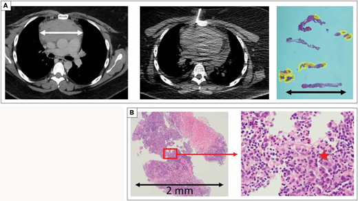 Case 3 illustrates that even under optimal sampling conditions, the amount of “tumor” obtained may be minimal. A) The computed tomography scan shows a 10 × 8 cm anterior mediastinal mass which appeared to safely and reasonably be approached by either an incisional biopsy or fine-needle aspiration/core needle biopsy (FNA/CNB). The FNA/CNB sampled what appears to be an appropriate volume of the tumor. However, the tissue sections show that most of the sample was fibrosis; the areas composed of lymphocytes are outlined in yellow. The lymphocytes in these limited areas, amounting to 0.06 cm2 in cross section, were correctly interpreted as non-neoplastic forms. With numerous small lymphocytes in the absence of any evidence of a neoplasm, an experienced pathologist interpreted these findings as a thymoma. On subsequent review, additional levels and studies were obtained specifically because the diagnosis of thymoma was based on the absence of neoplastic findings in an otherwise tiny specimen. Additional hematoxylin and eosin stain levels obtained from the original blocks showed rare, definitive Reed-Sternberg cells. B) Small samples are … sometimes tiny samples. And Reed-Sternberg cells are notoriously rare in Hodgkin lymphoma. Images show the most cellular piece of tissue at its largest is 2 mm. Within the red block are several variant forms of Reed-Sternberg cells, marked with a star in the high-power image.