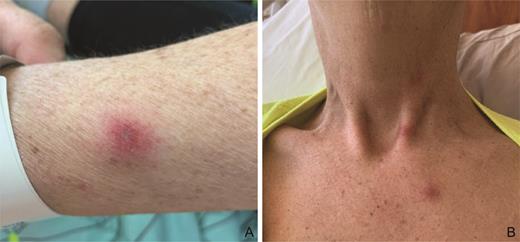 Edematous, bright pink papulovesicles scattered on the upper extremities (A) and neck and upper chest (B).