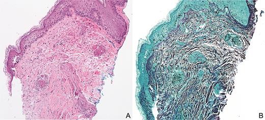 (A) Septated nonpigmented hyphae centered around blood vessels and extending into surrounding tissue with extravasated red blood cells with minimal associated inflammatory infiltrate (hematoxylin and eosin, 10×). (B) Grocott methenamine silver stain highlights fungal organisms (10×).