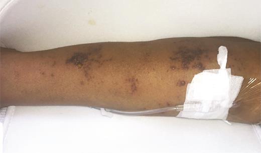 Clusters of monomorphic vesicles on the right upper extremity.