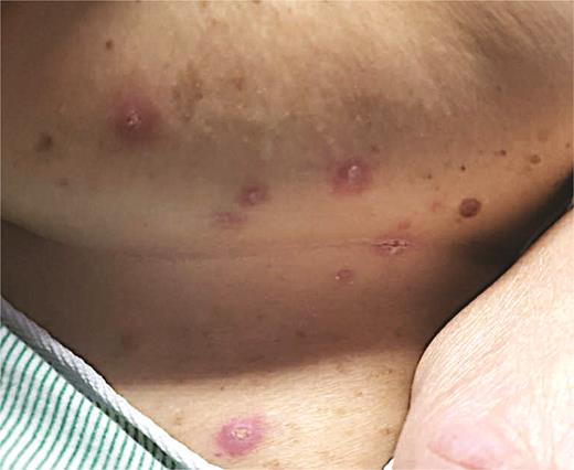 Pink to purple, edematous papulovesicles with variable erosion and ulceration concentrated in the inframammary and abdominal folds.