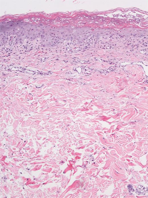 Epidermal dysmaturation with superficial and focal interface dermatitis composed of lymphocytes, neutrophils, and numerous eosinophils (hematoxylin and eosin, 10×).