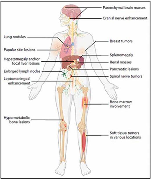 ALK-positive histiocytosis can affect numerous anatomic sites, with bone marrow and liver being most common in Group 1A, and nervous system, liver, lung, and bone being most common in Group 1B and Group 2 disease subgroups. Adapted from Figure 6, Kemps PG et al. ALK-positive histiocytosis: a new clinicopathologic spectrum highlighting neurologic involvement and responses to ALK inhibition. Blood. 2022;139:256-280.
