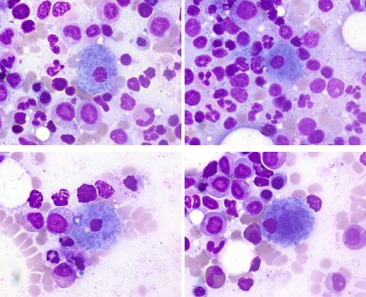 Bone marrow aspirate smears (modified Wright-Giemsa stain).