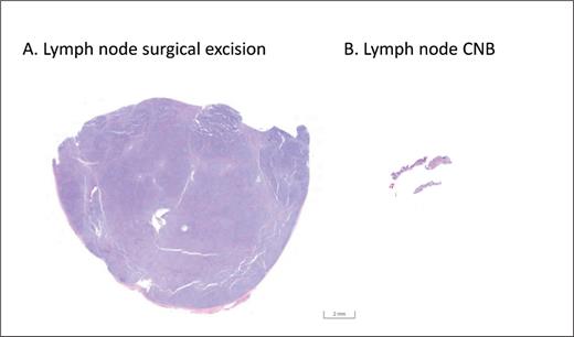 Low-power microscopic slide images of: A) a section of an excisional lymph node biopsy and B) a core needle biopsy (CNB), taken at the same magnification. The excisional biopsy contains a much larger sample of tissue, affording the pathologist an opportunity to more effectively evaluate tissue architecture and possible tumor heterogeneity.