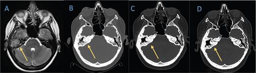 Axial T2 sequence of A) a brain MRI from 2019 demonstrates diffuse opacification of right mastoid air cells and lytic changes of the right temporal bone. A B) head computed tomography (CT) scan obtained in February 2021 shows erosion of the bony septate and partial opacification of the mastoid air cells. C) Nine months later, CT of the head reveals an interval decrease in the amount of fluid collection in the mastoid portion of temporal bone and reactive sclerotic changes. D) The most recent head CT in July 2022 shows stable changes.