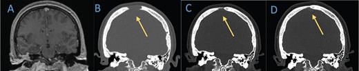 Coronal computed tomography (CT) head bone window demonstrates lytic lesion along the frontal cranium near the vertex which is not evident on the A) brain MRI from 2019. B-D) Subsequent head CTs obtained nine months later show significant interval decrease in size of the lytic lesions. Follow-up head CT in eight months demonstrates further evidence of healing.