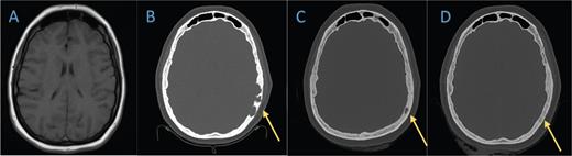 Axial bone window of (B) the head CT in February 2021 shows lytic lesions in the left temporal cranium that is not present on A) the brain MRI from 2019. C) Head CT in November 2021 demonstrates marked improvement of the lytic process. D) The last head CT obtained in July 2022 shows near resolution of the known lesion. palliative care. Early referral for psychological support and symptom management has been a beneficial strategy in many patients.7