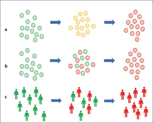 Three possible paradigms for defining smoldering myeloma: A) an intermediate cellular state that aligns with the diagnosis, (B) an increasing proportion of “myeloma cells” among the clonal plasma cells, or (C) a mixture of individuals who are true MGUS and those who have myeloma, but the end-organ damage has not manifested itself (likely the best definition).
