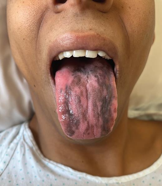 The dorsal aspect of the tongue showing hyperpigmented macules.