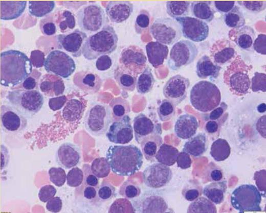 Bone marrow aspirate smear. The figure shows erythroid hyperplasia with increased density of left-shifted erythroid precursors, dyserythropoeiesis, and cytoplasmic vacuolization of a subset of erythroid precursors.