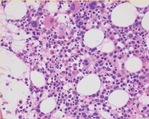 Bone marrow core biopsy. The bone marrow is normocellular for the patient’s age and is characterized by a decreased myeloid-erythroid ratio with morphologically unremarkable megakaryocytes.
