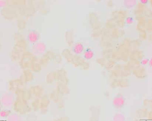 Iron stain performed on the bone marrow aspirate smear. Ring sideroblast counts are increased.