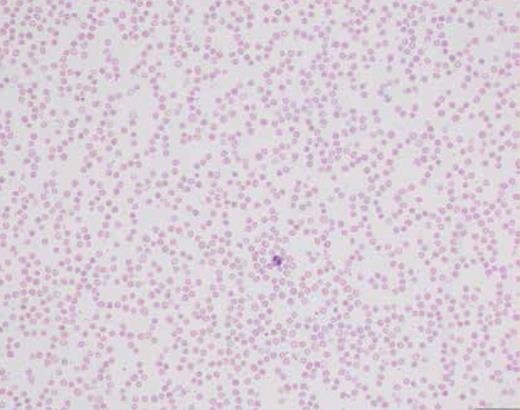 Peripheral blood smear. The figure shows marked anemia and neutropenia with adequate platelets.