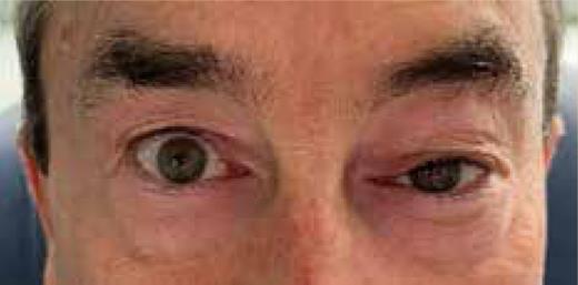Mechanical ptosis at the level of the left orbit. Patient consent obtained.