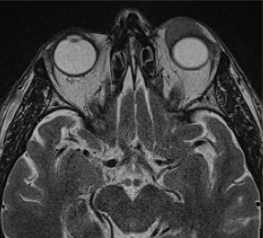 Axial MRI showing a lesion in the extraconal compartment of the left orbit.