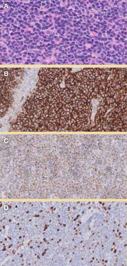 Biopsy findings. A: Magnified image of hematoxylin and eosin (H&E) staining; B: CD20+ staining; C: Reaction of the tumor cells with anticyclin D1; D: Low Ki67 index.