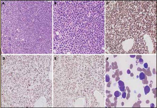 Bone marrow core biopsy showing infiltration by large lymphoid cells, extensively replacing normal hematopoietic elements. (A, hematoxylin and eosin, 200x). The lymphoid cells are large and have irregular nuclear contours with an increased nuclear-to-cytoplasmic ratio (B, hematoxylin and eosin, 400x) The lymphoid infiltrate is positive for PAX5 (C), showing aberrant overexpression of p53 (D) and a high Ki-67 proliferation index (E). (C-E; immunohistochemistry with hematoxylin counterstain, 200x). The bone marrow aspirate smear shows increased numbers of large, atypical lymphoid cells with prolymphocytoid morphology (F, Giemsa, 1,000x).