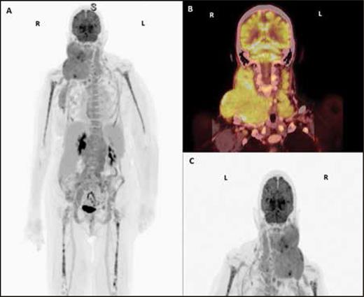(A-C). PET/CT scan with contrast showing conglomerates of hypermetabolic lymph nodes in the right neck displacing the right oropharynx and extension to the right axilla, with an index lesion of 6.2 x 5.5 cm and standardized uptake value (SUV) of 8.2, and hypermetabolic lymph nodes in the left supraclavicular stations, with an index lesion of 1.7 x 1 cm and an SUV of 3.7.