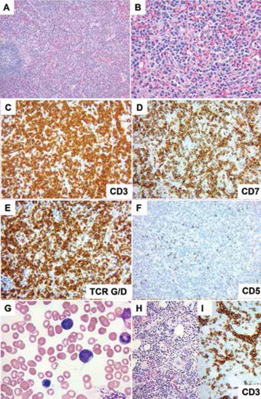 The spleen image shows monotonous proliferation of medium-sized lymphocytes with pale cytoplasm infiltrating dilated splenic sinuses (A, hematoxylin and eosin, 100x; B, hematoxylin and eosin, 400x). The cells are strongly positive for CD3 (C), CD7 (D), TCR gamma/delta (E), and negative for CD5 (F) (C-F, immunohistochemistry with hematoxylin counterstain, 200x).