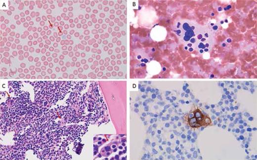 Peripheral blood showed agranular platelets with variable size (A, Wright stain, 1000×). Bone marrow touch preparation showed a megakaryocyte with prominent (B, Giemsa stain, 1000×). Bone marrow biopsy showed normocellular bone marrow (70%) with trilineage hematopoiesis and frequent emperipolesis in megakaryocytes (C, hematoxylin and eosin stain, 400×; inset, 1000×). The CD61 stain highlights megakaryocyte emperipolesis (D, immunohistochemistry with hematoxylin counterstain, 1000×).