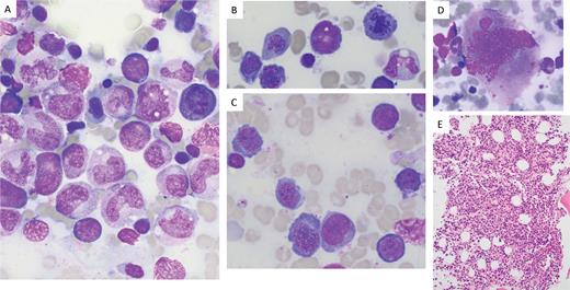 The patient’s folate level at the time of biopsy was 1.4 ng/mL (reference range: 7.0-31.0 ng/mL). Peripheral blood counts normalized after folate repletion. Myeloid precursors show megaloblastic changes, including giantism of bands and metamyelocytes (A, 100X). The erythroid precursors show nuclear-cytoplasmic asynchrony, as well as nuclear budding and late mitoses (A, B, 100X; C, 50X). The megakaryocytes also show nuclear abnormalities (D, 50X). The marrow hypercellularity is seen on hematoxylin-and-eosin-stained section of the core biopsy (E, 20X). Lacking from this case is the marked erythroid predominance and erythroid left-shift that can be seen in some cases of vitamin B12 or folate deficiency.