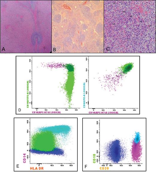Ras-associated autoimmune leukoproliferative disorder: histopathological and flow cytometry findings