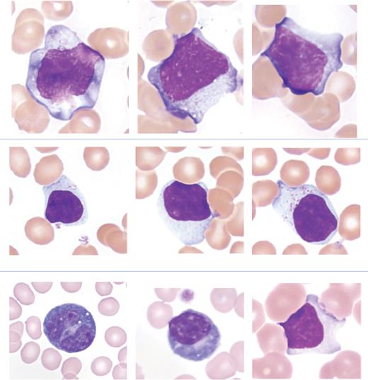 Examples of reactive lymphocytes