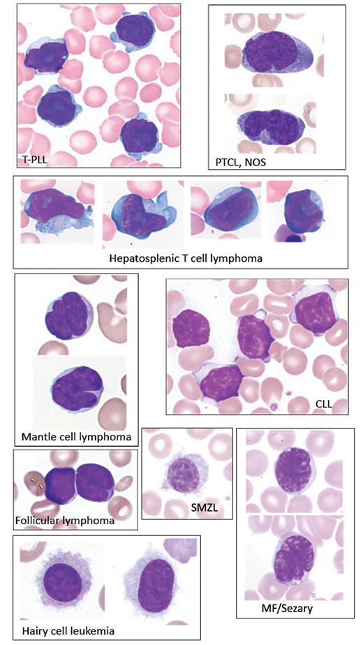 Examples of circulating lymphoma cells