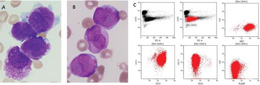 Example morphology and immunophenotype of acute promyelocytic leukemia