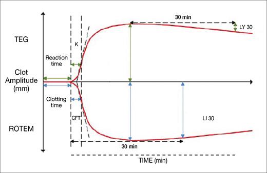 Representation of the variables obtained from a thromboelastography and rotational thromboelastometry trace