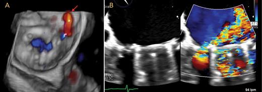 Images from three-dimensional transesophageal echocardiography