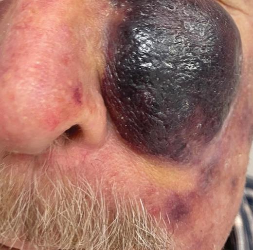 Typical presentation of a cutaneous blastic plasmacytoid dendritic cell neoplasm lesion