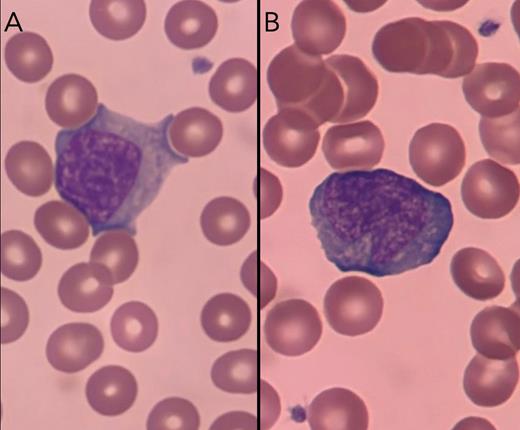 Peripheral blood smear