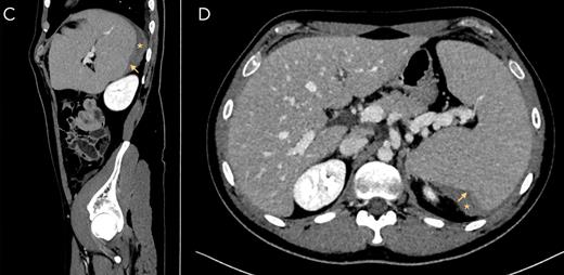 Computed tomography of splenic rupture