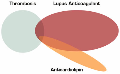 Figure 1: Anticardiolipin Antibodies Alone are not a Risk Factor for Thrombosis. Some patients with lupus anticoagulants have thrombi and some also have anticardiolipin antibodies. Anticardiolipin antibodies are not associated with thrombi unless a lupus anticoagulant is also present.