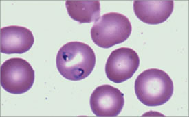 Characteristic Ring Forms can be Seen Within the Erythrocytes. From Maslak, P. ASH Image Bank. 2008:8-00003.