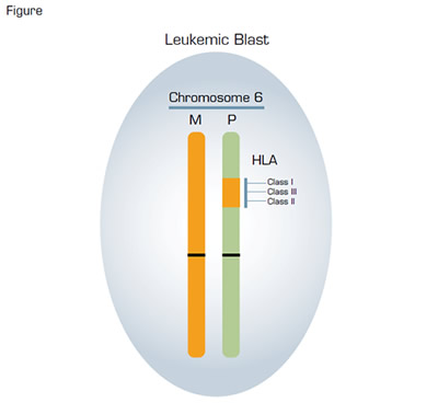 Acquired Uniparental Disomy in a Leukemic Blast in a Patient in Relapse Following Haploidentical Transplant. In the example illustrated, the original mismatched HLA alleles were located on the paternal (P) chromosome 6. During mitosis, a recombinant event occurred in one of the leukemic blasts in which a portion of the long arm of chromosome 6 containing the HLA loci was exchanged between a maternal and a paternal chromosome 6. Subsequently, a leukemic blast derived from this process contained the original maternal (M) chromosome 6 (orange) paired with the recombinant paternal chromosome 6 (green). That particular leukemic blast acquired a survival advantage in the setting of haplounidentical transplantation because it no longer expressed the mismatched paternal HLA proteins, thereby escaping immune surveillance by donor T cells that were haploidentical at the maternal HLA loci. Such recombinant events are not detected by standard karyotyping because there is no observable net loss or gain of genetic material. However, this process can be identified by using single nucleotide polymorphism-array analysis and is called copy number neutral loss of heterozygosity.