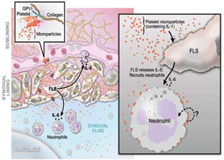 Proposed Pathway for GPVI-Dependent Participation of Platelets in Arthritis via Microparticles. GPVI-expressing platelets activated by collagen produce copious amounts of IL-1-rich microparticles (MPs) (left panel and inset). The precise anatomic location of platelet activation and the route by which microparticles enter the joint (dotted red line in the left side of the figure where the microparticles are going across the synovial lining) remain unknown. Platelet MPs (~0.2-1 μm in diameter), detectable at high levels in inflammatory synovial fluid, interact with tissue cells including fibroblast-like synoviocytes (FLS) and synovial fluid leukocytes (right panel). This interaction elicits further inflammatory effector functions from target cells, thereby amplifying synovitis. In the case of FLS, platelet MPs promote elaboration of IL-8 and other mediators that are capable of leukocyte chemoattraction to the joint (right panel). Platelet microparticles attached to neutrophils, as found in diseased synovial fluid, may also stimulate neutrophil effector functions, although this remains to be established (question mark, right panel). Figure courtesy of S. Moskowitz and D. Lee.