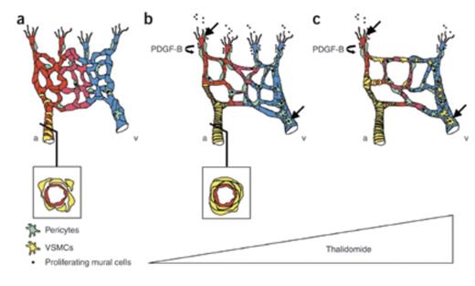 Schematic Illustration of How Thalidomide Normalizes Vascular Malformations in HHT. a) Reduced expression of endoglin or ALK-1 in endothelial cells reduces pericyte recruitment. Smooth muscle cell coverage of arteries is irregular, and vessels show endothelial hyperplasia and irregular capillary diameter. b) A low dose of thalidomide normalizes vessel coverage defects and excessive angiogenesis by stimulating mural cell recruitment. Mechanisms of thalidomide-induced vessel maturation include increased PDGF-B expression from the endothelial tip cells, which attracts co-migrating mural cells, and direct stimulation of mural cell proliferation. c) A high dose of thalidomide enhances the number of mural cells expressing α-SMA, indicating vessel maturity, and inhibits angiogenesis. Black arrows indicate that thalidomide targets both endothelial tip cells and mural cells directly to control vessel growth and maturation. a = artery; v = vein. Schematic illustration of how thalidomide normalizes vascular malformations in HHT.Figure Reprinted with permission from Macmillan Publishers Ltd: Nature Medicine (Lebrin F, Srun S, Raymond R, et al. Nat Med. 2010;16:420-428.) Copyright 2010.