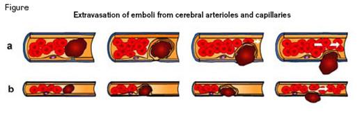 Flow is Reestablished Rapidly During the Extravasation Process Allowing Vessel Survival. (a) In arterioles > 20 μm in diameter, blood flow is reestablished, at least partially, even before complete embolus extravasation given that multiple rows of cells can circulate simultaneously. (b) In capillaries, blood flow is generally reestablished following complete embolus translocation.Reprinted by permission from Macmillan Publishers Ltd: Nature (Lam CK, Yoo T, Hiner B, et al. Nature 2010;465:478-482), copyright 2010.