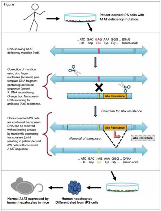 . / The investigators 1) created induced pluripotent stem cells (iPSCs) from patients with PiZZ-associated A1AT deficiency; 2) designed zinc finger nucleases to specifically nick the DNA flanking the mutation in the A1AT gene; 3) replaced the region of genomic DNA containing the mutation with a fragment of DNA containing not only the corrected gene sequence, but also a transposon, which allows for selective growth of corrected iPSCs; 4) removed the transposon without leaving a trace; 5) assessed for corrected clones that had not undergone additional mutations during the procedures using deep sequencing, genome hybridization, and other approaches; and 6) differentiated the iPSCs into functional hepatocytes that were transplanted into immunodeficient mice, where they functioned to produce human albumin and the corrected A1AT protein.